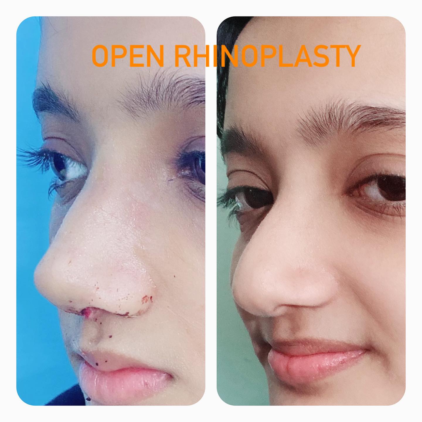 Rhinoplasty result